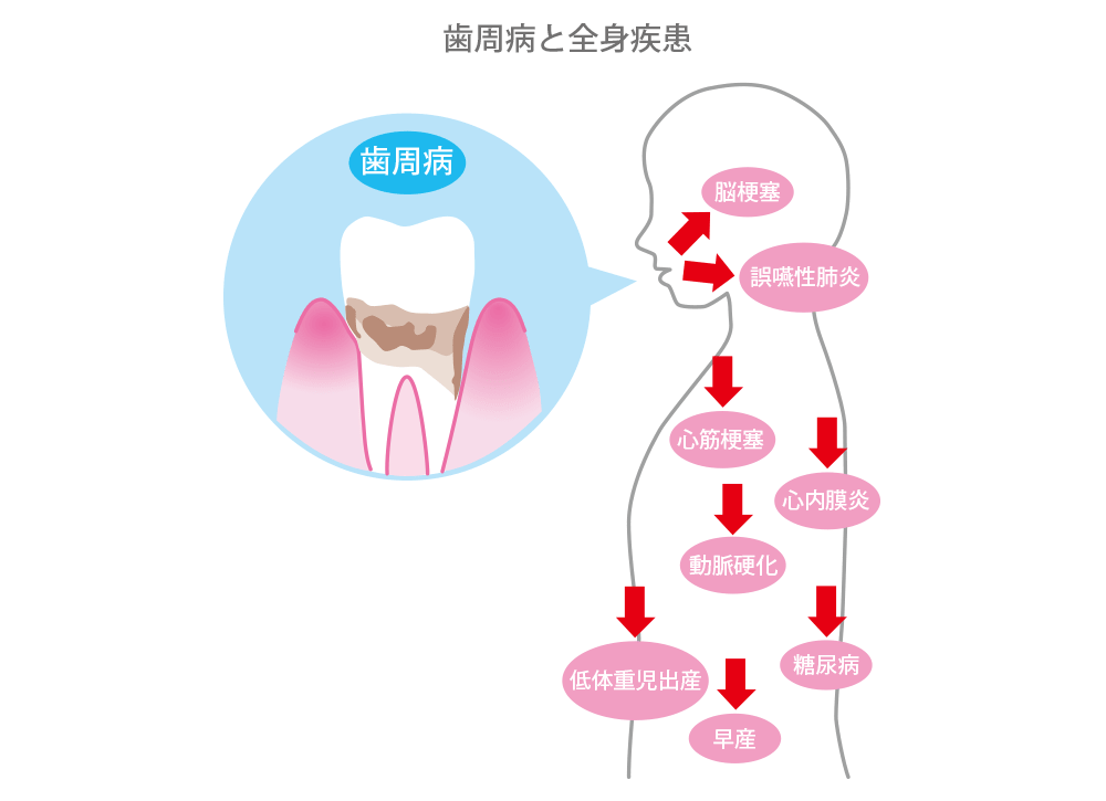 歯周病と全身疾患